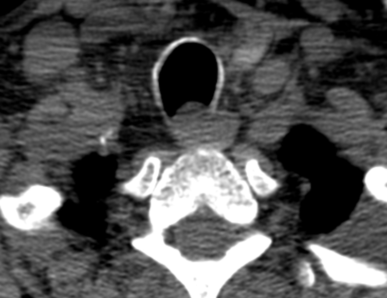 Anterior cervical postdiscectomy arthrodesis (Radiopaedia 32678-33646 Axial non-contrast 68).jpg