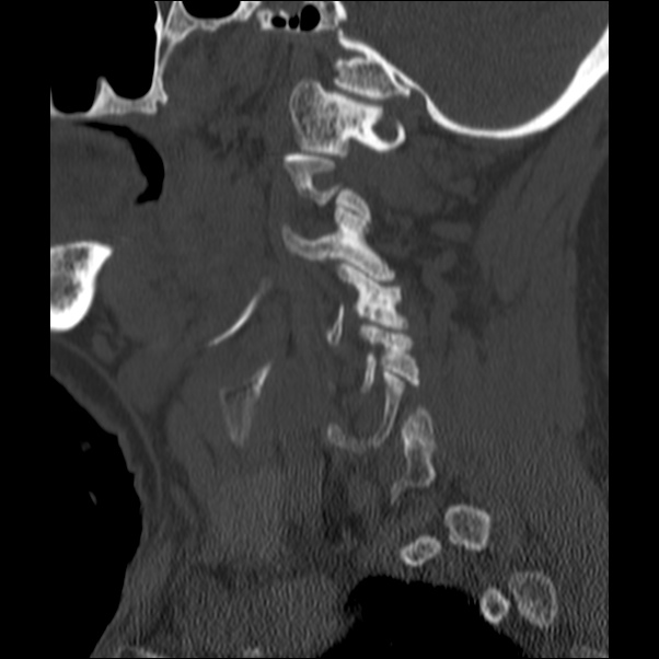 Anterior cervical postdiscectomy arthrodesis (Radiopaedia 32678-33646 Sagittal bone window 16).jpg
