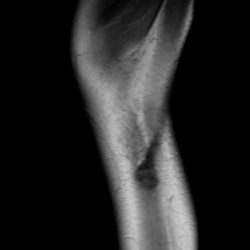 File:Anterior cruciate ligament avulsion fracture (Radiopaedia 24710-24974 Sagittal T1 13).jpg