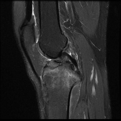 File:Anterior cruciate ligament avulsion fracture (Radiopaedia 58939-66193 Sagittal PD fat sat 12).jpg