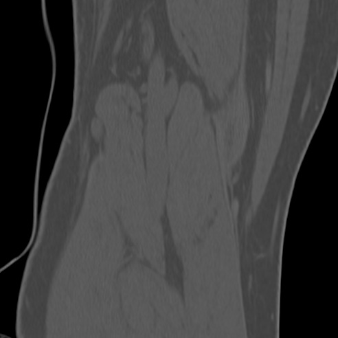 File:Anterior cruciate ligament avulsion fracture (Radiopaedia 58939-66194 Coronal bone window 33).jpg