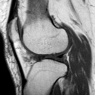 File:Anterior cruciate ligament mucoid degeneration (Radiopaedia 60853-68633 Sagittal T1 49).jpg