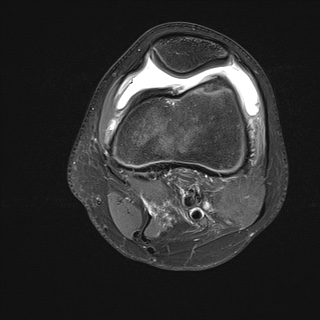 File:Anterior cruciate ligament tear - pediatric (Radiopaedia 62152-70260 Axial PD fat sat 10).jpg