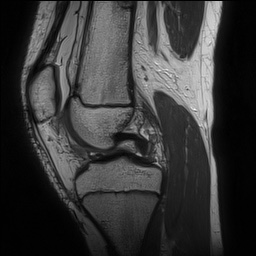 File:Anterior cruciate ligament tear - pediatric (Radiopaedia 62152-70260 Sagittal PD 77).jpg