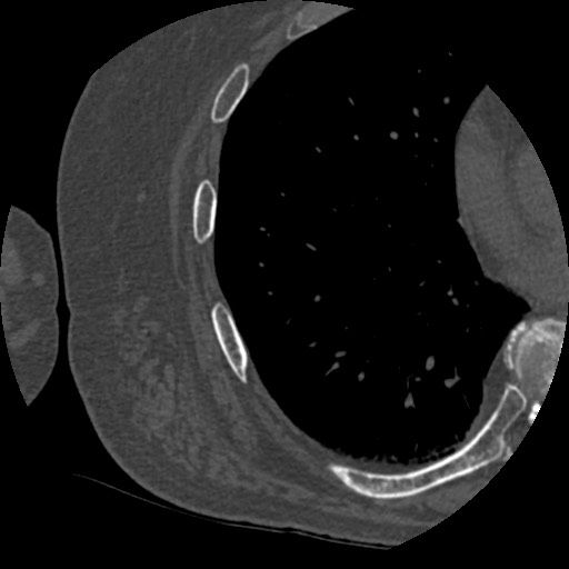 File:Anterior glenohumeral dislocation with Hill-Sachs lesion (Radiopaedia 62877-71249 Axial bone window 118).jpg