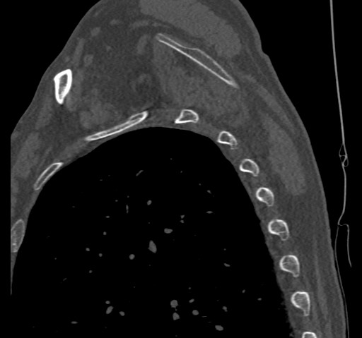 Anterior glenohumeral dislocation with Hill-Sachs lesion (Radiopaedia 62877-71249 Sagittal bone window 58).jpg