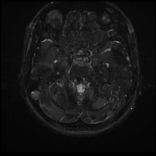 Anterior inferior cerebellar artery vascular loop - type II (Radiopaedia 70991-81209 Axial 3D FIESTA 2).jpg