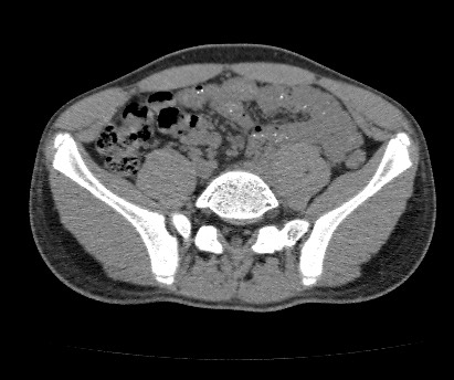 Anterior inferior iliac spine avulsion fracture (Radiopaedia 81312-94999 Axial non-contrast 22).jpg