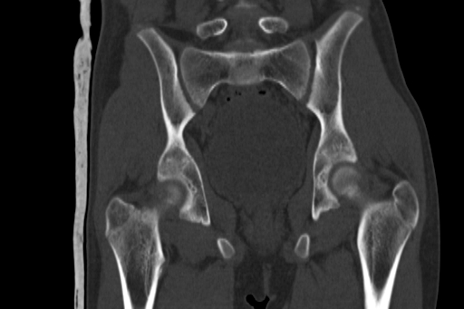 Anterior inferior iliac spine avulsion injury (Radiopaedia 88666-105376 Coronal bone window 43).jpg