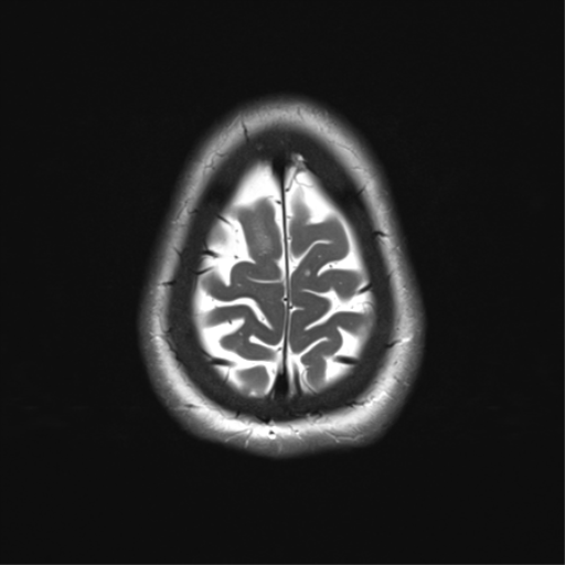 File:Anterior temporal pole cysts (Radiopaedia 46629-51102 C 34).png