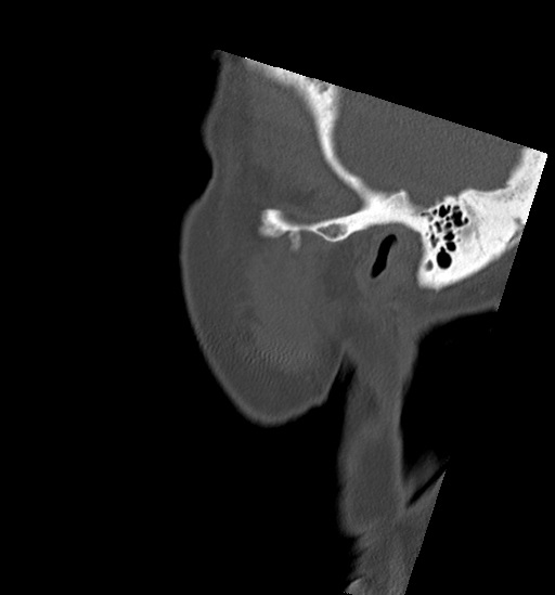 Anterior temporomandibular joint dislocation (Radiopaedia 59430-66784 B 3).jpg