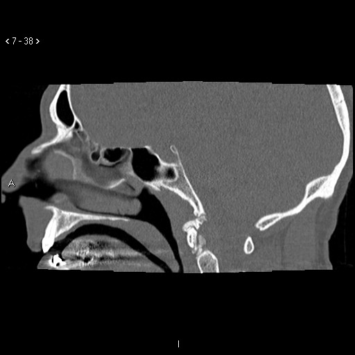 File:Antrochoanal Polyp (Radiopaedia 70510-80631 Sagittal bone window 28).jpg