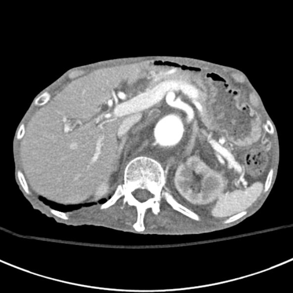 File:Aortic aneurysm with spinal destruction (Radiopaedia 42301-45410 A 24).jpg