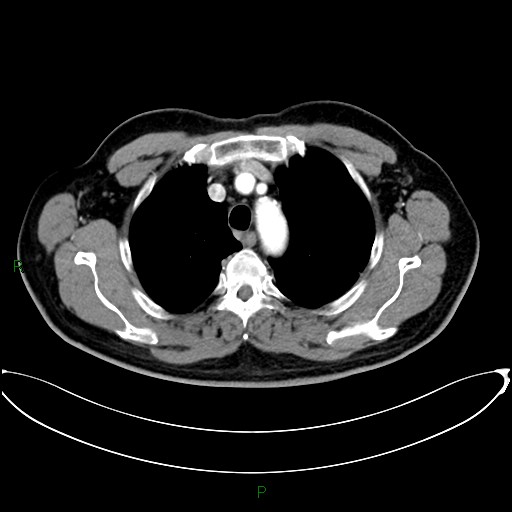 File:Aortic arch origin of left vertebral artery (Radiopaedia 46327-50737 Axial post contrast 29).jpg