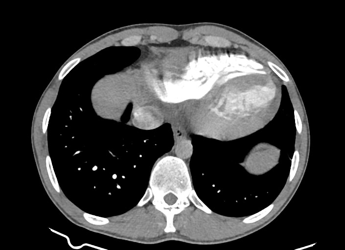 File:Aortic coarctation with aneurysm (Radiopaedia 74818-85828 A 58).jpg