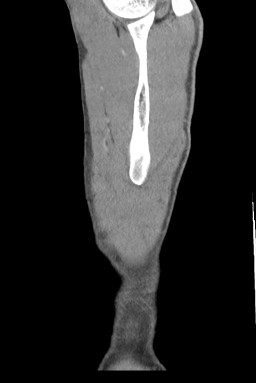 Aortic coarctation with aneurysm (Radiopaedia 74818-85828 B 155).jpg