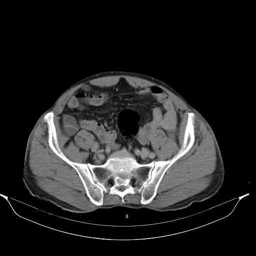 File:Aortic dissection- Stanford type A (Radiopaedia 22085-22085 Axial C+ delayed 41).jpg