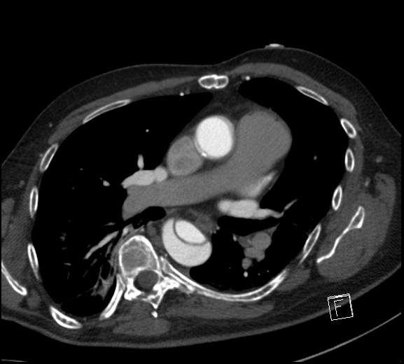 Aortic dissection (CTPA) (Radiopaedia 75506-86750 A 47).jpg