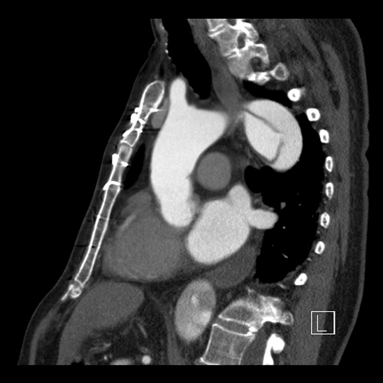 File:Aortic dissection (CTPA) (Radiopaedia 75506-86750 C 58).jpg
