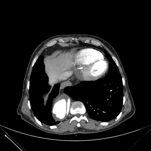 Aortic dissection (Radiopaedia 27466-27665 C+ arterial phase 230).jpg