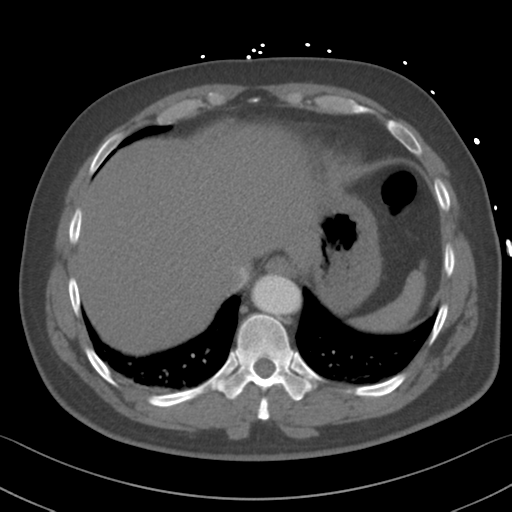 File:Aortic dissection (Radiopaedia 50763-56234 A 62).png