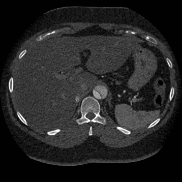 File:Aortic dissection (Radiopaedia 57969-64959 A 305).jpg