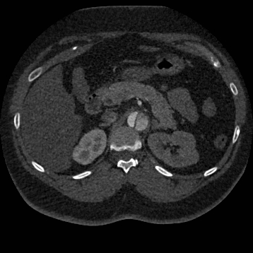File:Aortic dissection (Radiopaedia 57969-64959 A 353).jpg
