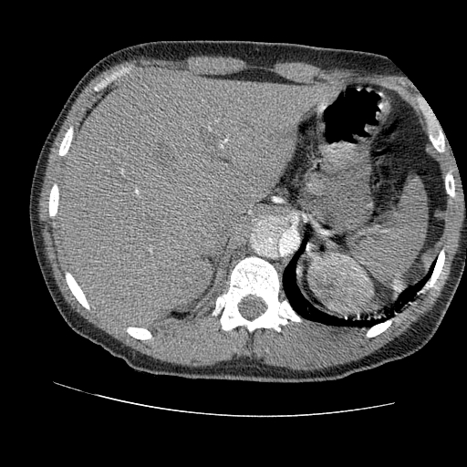 File:Aortic dissection - Stanford A -DeBakey I (Radiopaedia 28339-28587 B 104).jpg