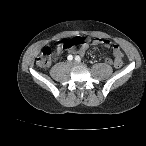 File:Aortic dissection - Stanford A -DeBakey I (Radiopaedia 28339-28587 B 168).jpg