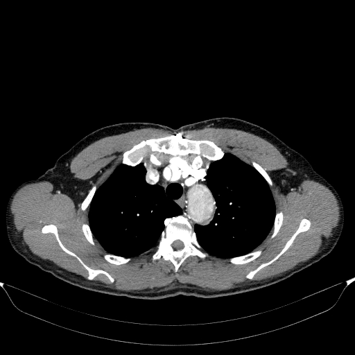 File:Aortic dissection - Stanford type A (Radiopaedia 83418-98500 A 15).jpg