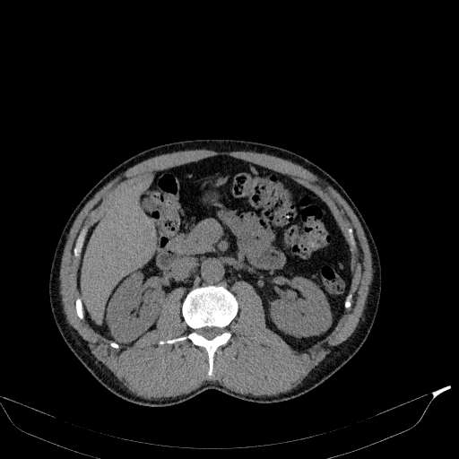 File:Aortic dissection - Stanford type A (Radiopaedia 83418-98500 Axial non-contrast 52).jpg