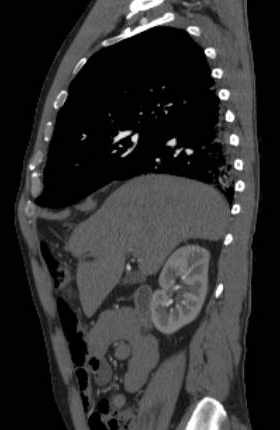 File:Aortic dissection - Stanford type B (Radiopaedia 73648-84437 C 109).jpg