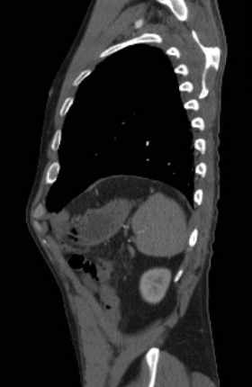 File:Aortic dissection - Stanford type B (Radiopaedia 73648-84437 C 24).jpg