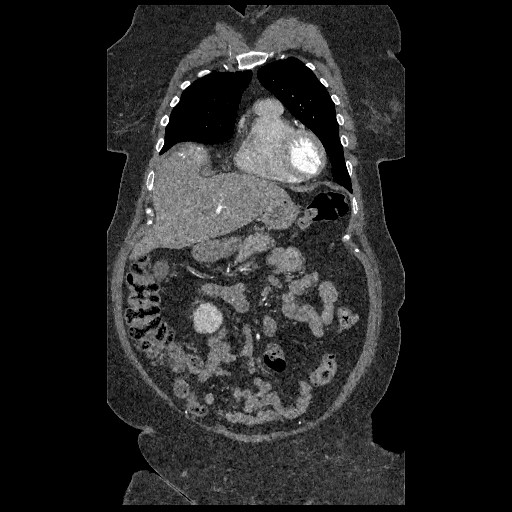 File:Aortic dissection - Stanford type B (Radiopaedia 88281-104910 B 12).jpg