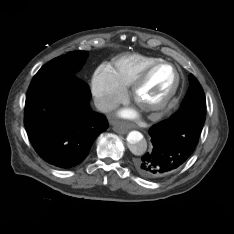 Aortic dissection with rupture into pericardium (Radiopaedia 12384-12647 A 42).jpg