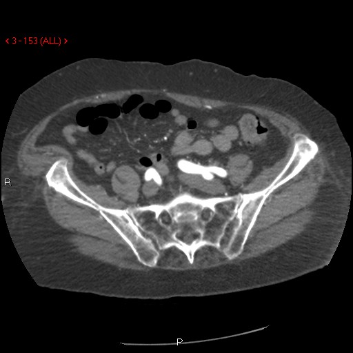 File:Aortic intramural hematoma (Radiopaedia 27746-28001 A 153).jpg
