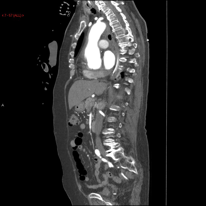 Aortic intramural hematoma (Radiopaedia 27746-28001 C 26).jpg