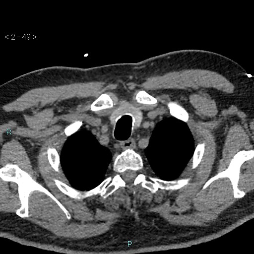 Aortic intramural hematoma (Radiopaedia 48463-53380 Axial non-contrast 21).jpg