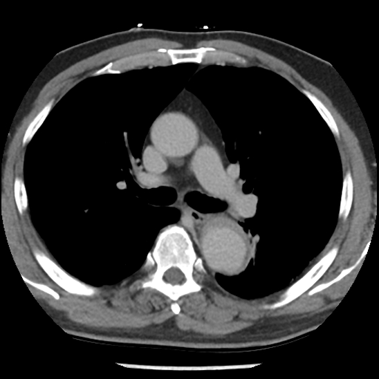 Aortic intramural hematoma (type B) (Radiopaedia 79323-92387 Axial C+ delayed 21).jpg