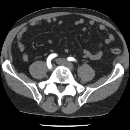 Aortic intramural hematoma (type B) (Radiopaedia 79323-92387 B 88).jpg