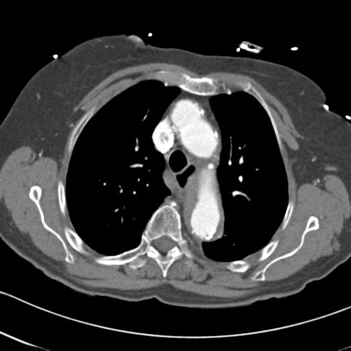 Aortic intramural hematoma from penetrating atherosclerotic ulcer (Radiopaedia 31137-31836 A 24).jpg