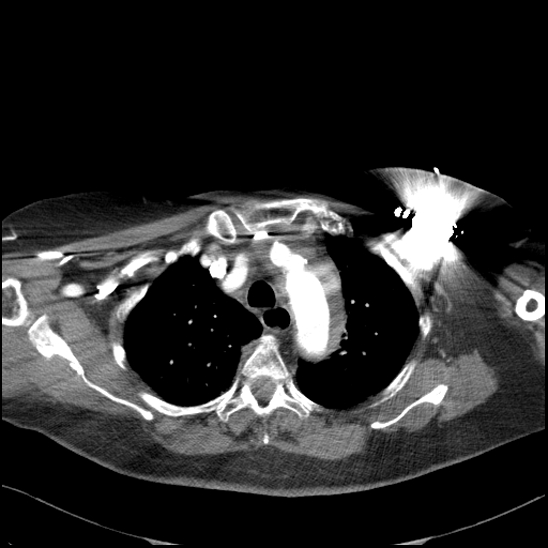 Aortic intramural hematoma with dissection and intramural blood pool (Radiopaedia 77373-89491 B 37).jpg