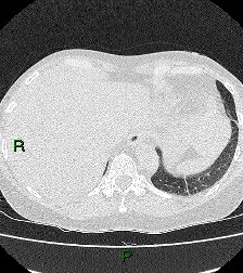 File:Aortic valve endocarditis (Radiopaedia 87209-103485 Axial lung window 85).jpg