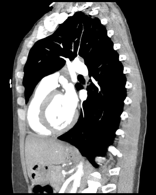 Aortic valve non-coronary cusp thrombus (Radiopaedia 55661-62189 D 23).png