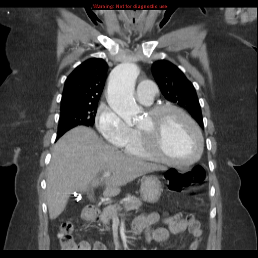 File:Aortic valve stenosis (Radiopaedia 14480-14423 A 5).jpg