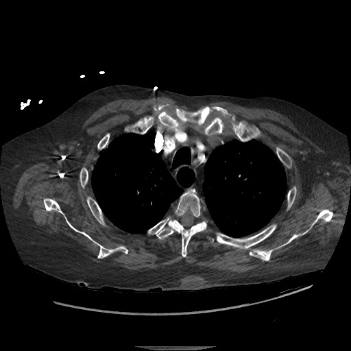 Aortoesophageal fistula with endovascular repair (Radiopaedia 73781-84592 Axial C+ CTPA 20).jpg