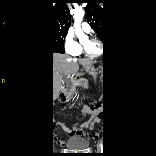 File:Aortoiliac occlusive disease (Radiopaedia 16828-16548 B 28).jpg