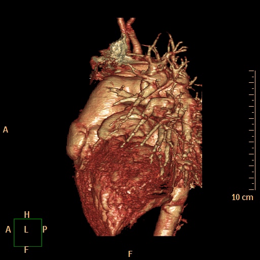 File:Aortopulmonary septal defect (Radiopaedia 41990-45013 3D reconstruction 6).jpg