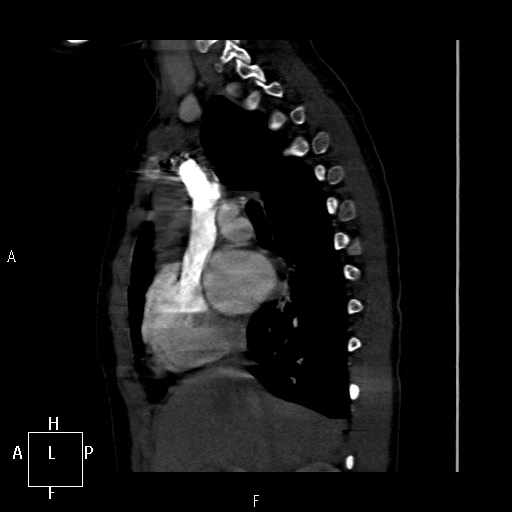 File:Aortopulmonary septal defect (Radiopaedia 41990-45013 Sagittal C+ CTPA 37).jpg