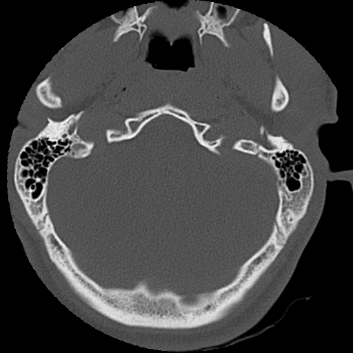 Apical pneumothorax on cervical spine CT (Radiopaedia 45343-49368 Axial bone window 1).jpg